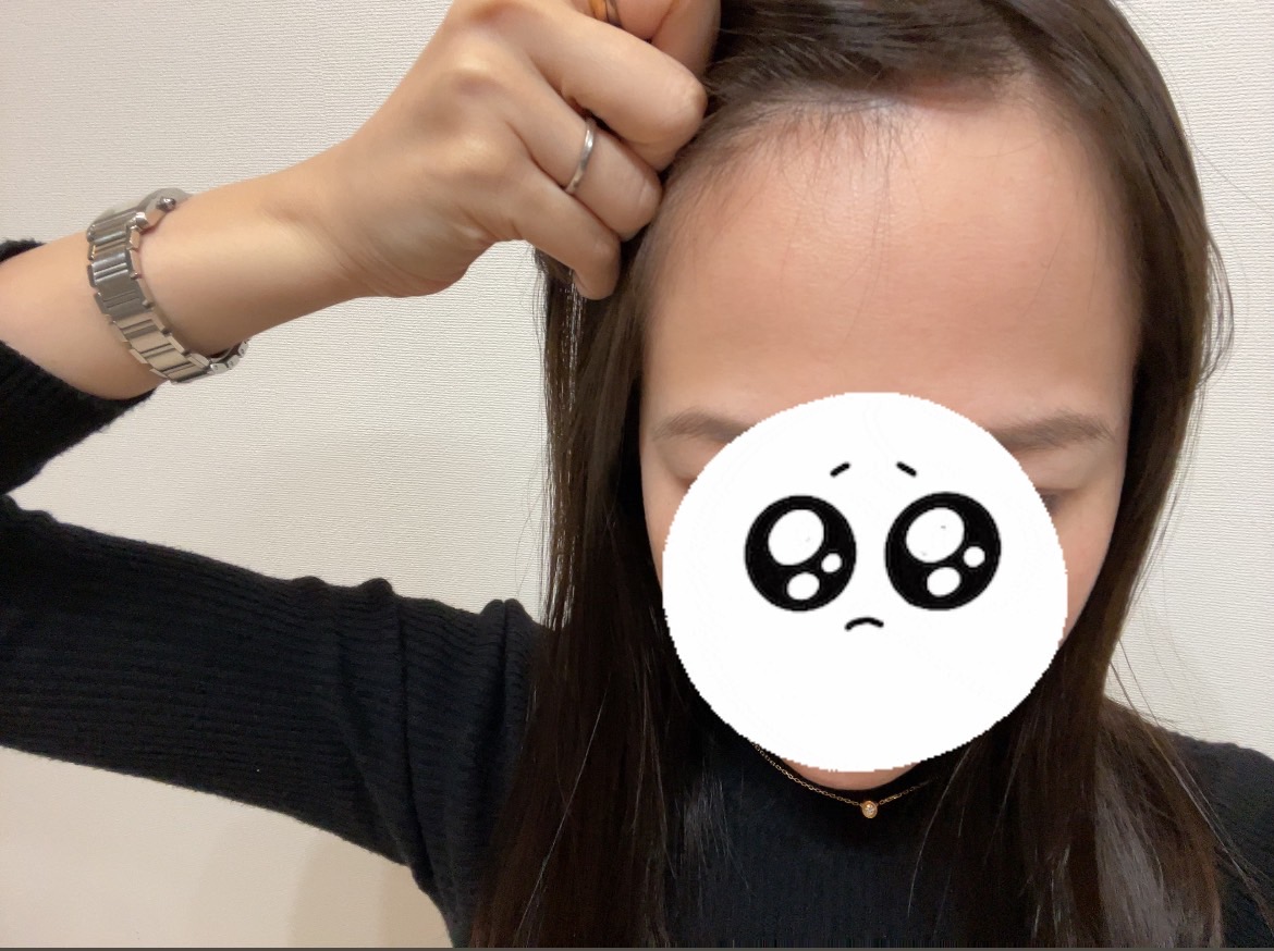 生え際の薄毛が気になる状態(治療前)