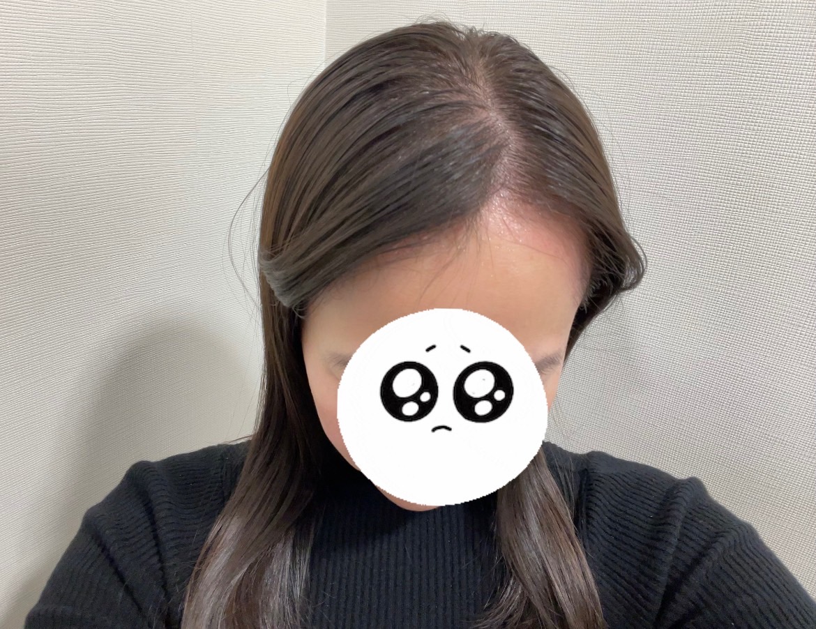 クイックメソ施術直後の頭頂部(ダウンタイム・赤みが出ている状態)